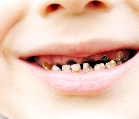 More than a quarter of kids have tooth decay