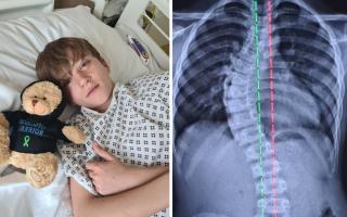 Sam was diagnosed with scoliosis in 2021 as his spine had a 53-degree curve