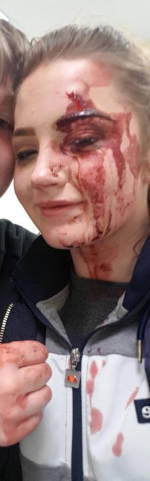 Teenage girl suffers wound above eye in unprovoked attack