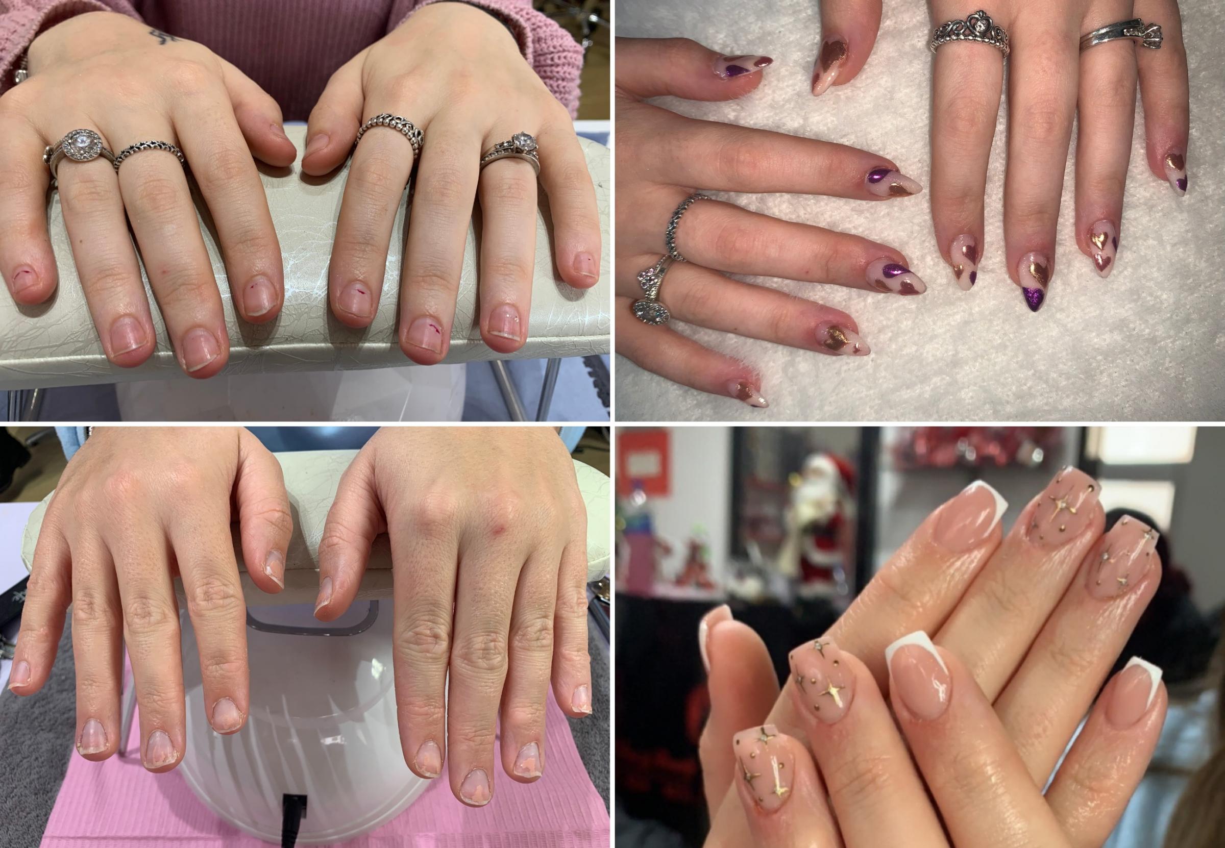 Before and after nail treatment