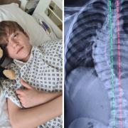 Sam was diagnosed with scoliosis in 2021 as his spine had a 53-degree curve